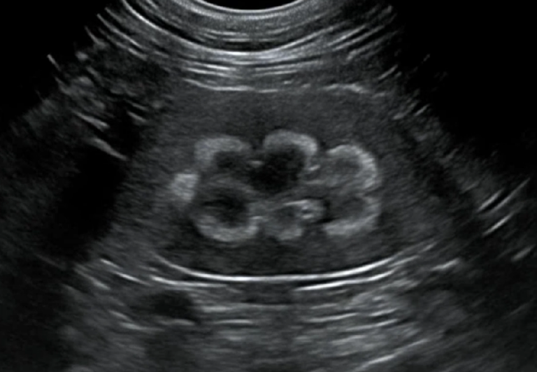 Objaw rąbka rdzeniowego w ultrasonografii nerek psów i kotów — między wariantem anatomicznym a potencjalnym sygnałem uszkodzenia nerek