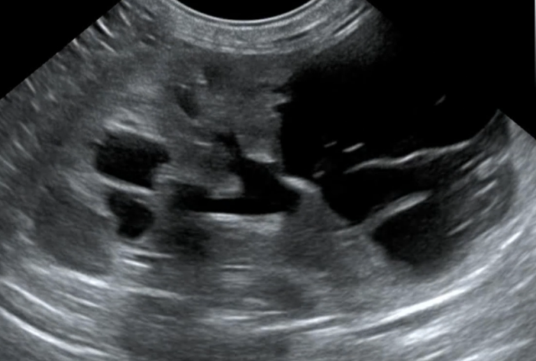 Polycystic kidney disease (PKD) – wielotorbielowatość nerek